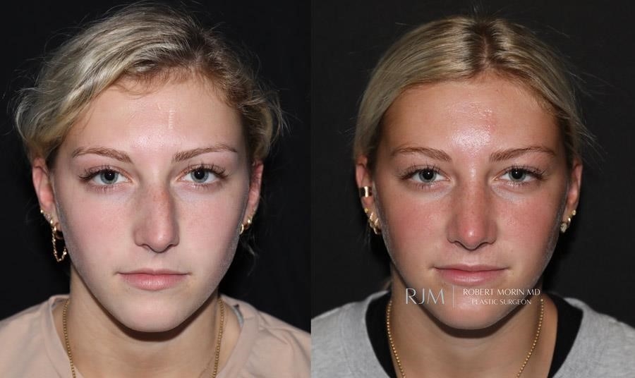 open vs closed rhinoplasty